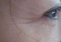 有没有什么办法可以预防眼角纹的出现啊？