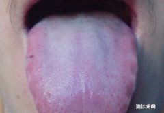 舌癌切除后影响说话吗