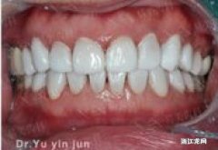 牙齿贴面有什么优点 牙齿贴面的主要材料是什么